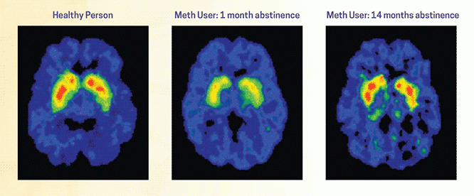 Brain scans comparing the brain of someone who stopped using month after 1 and 14 months of abstinence vs the brain of a healthy person. 