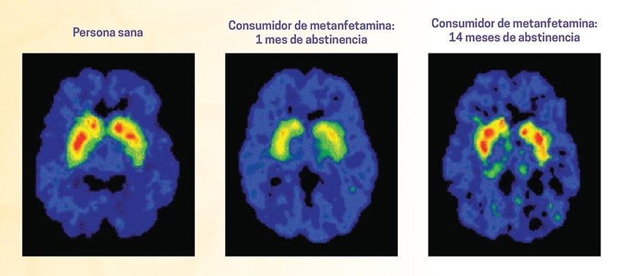 Estas imágenes en las que se observa la densidad de los transportadores de dopamina en el cerebro ilustran la sorprendente capacidad que tiene el cerebro para recuperarse, al menos parcialmente, después de una larga abstinencia de las drogas, en este caso, metanfetamina
