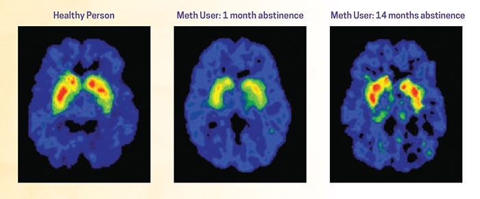 PET images showing damage to Dopamine transporters in a meth user after 1 months abstinence,  significant reduction in activity compared to normal brain, but after 24 months abstinence,  transporters have nearly returned to normal