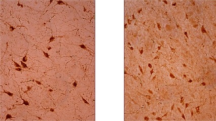 The left image shows hypocretin neurons in a normal human brain; the right image is hypocretin neurons in a person using heroin. The hypocretin neurons for the heroin user are much smaller and numerous.